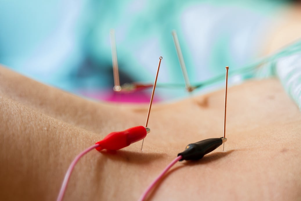 Acupuncture